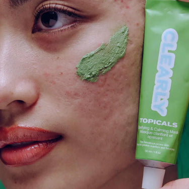 Mineral sunscreen for melasma protection shown as green Clearly mask applied to acne-prone cheeks.